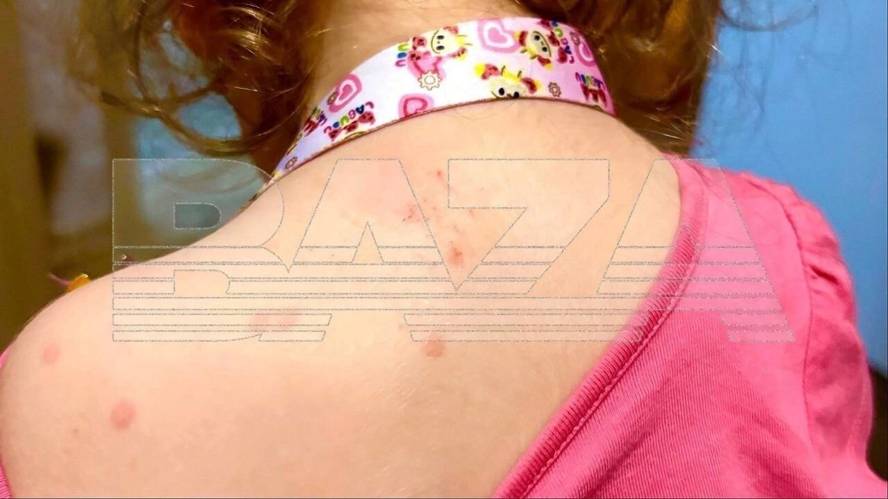 Рост заболеваемости энтеровирусными инфекциями наблюдался в&nbsp;стране с&nbsp;конца мая