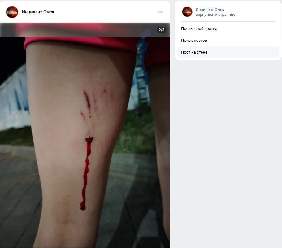 Несовершеннолетнюю омичку укусила за ногу собака