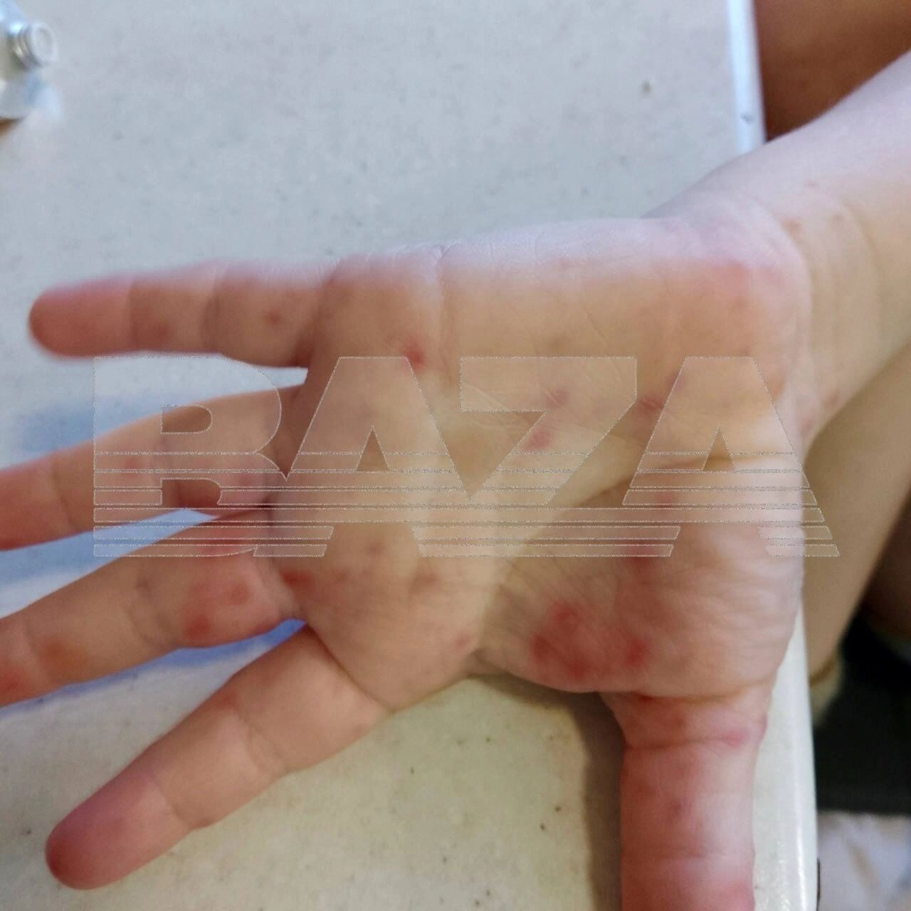 Рост заболеваемости энтеровирусными инфекциями наблюдался в стране с конца мая