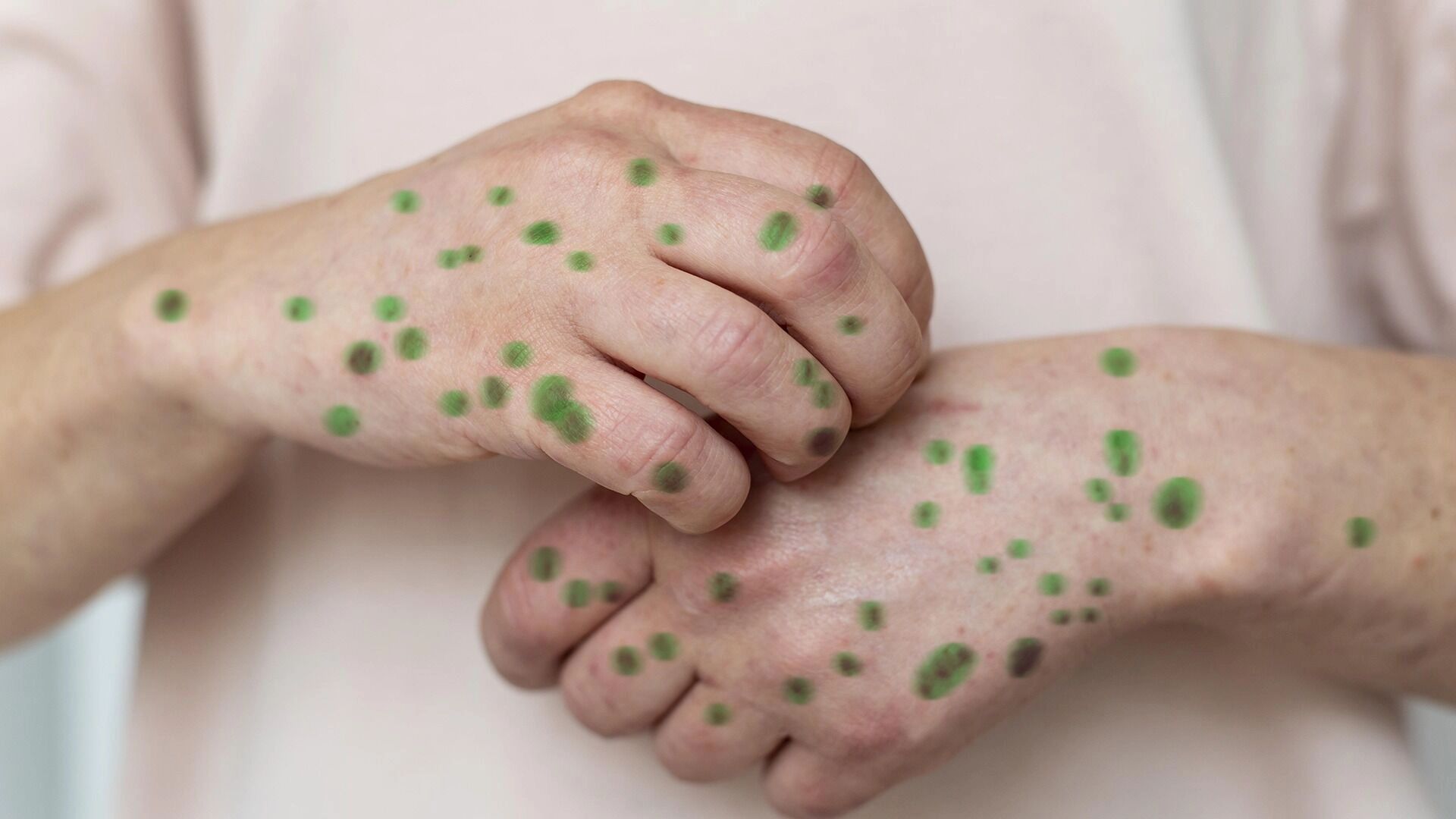 Волгоградцев предупредили об опасности ветрянки