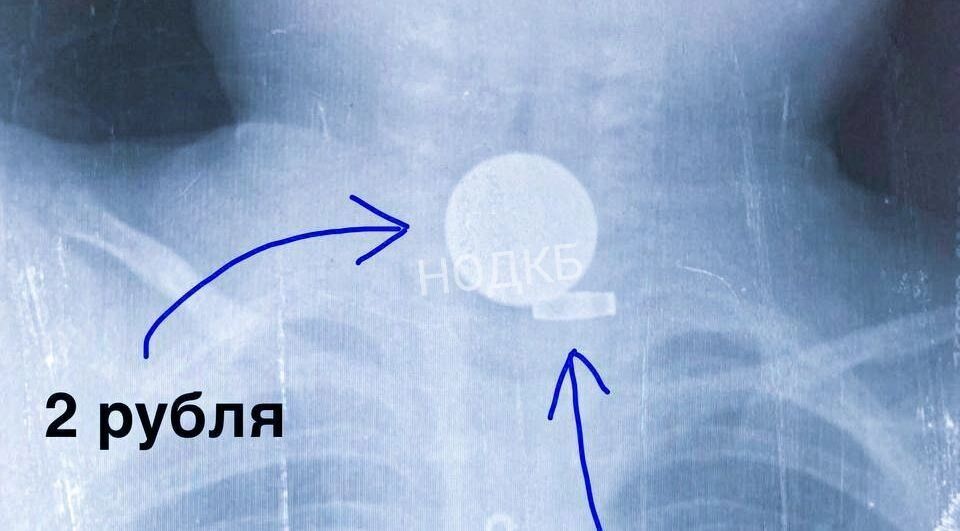 Из пищевода нижегородского ребенка достали двухрублевую монету